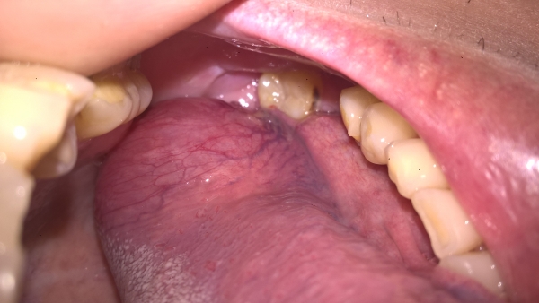 Зуб не болит, а щека опухла — причины патологического состояния