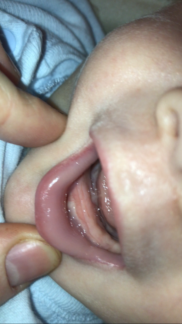Гиперплазия (десна нарастает на зуб): причины и лечение — ROOTT
