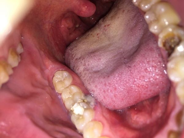 Что делать, если выпала временная пломба – статьи стоматологической клиники «Доктор Мартин»