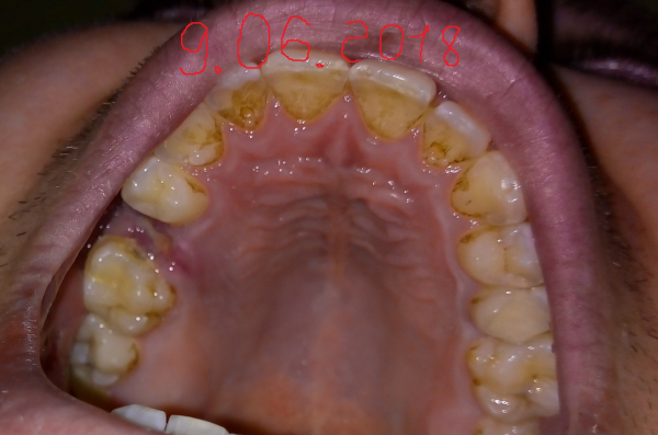 Осложнения при зубной имплантации: вероятность и причины осложнений
