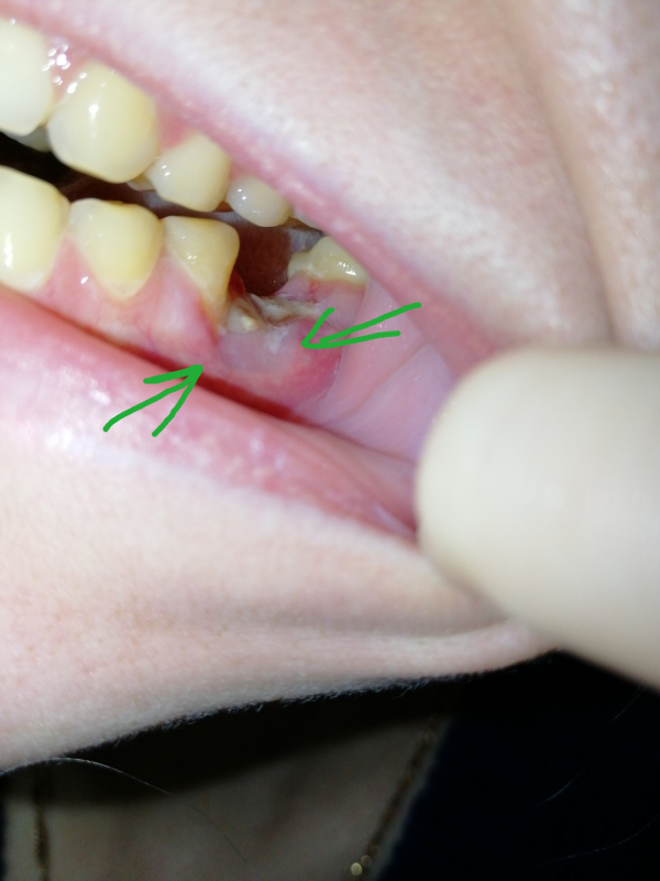 Зарастет ли кость, которая торчит из десны после удаления коренного зуба?