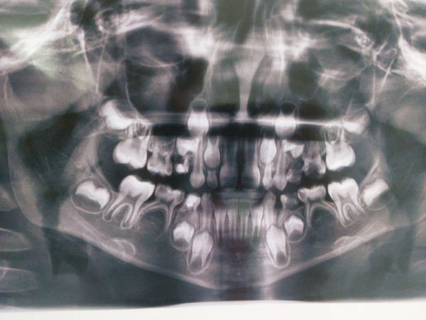 Рентген детских зубов с молочных фото