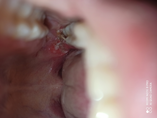 Осложнения после удаления зуба - Хирургическая стоматология - Стоматология для всех