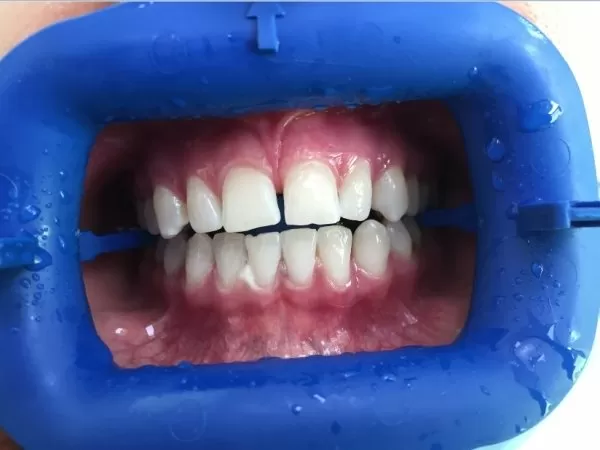 Нарушения цвета зубов: причины и методы лечения