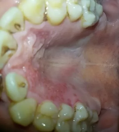 Поражения слизистой оболочки рта травматического происхождения