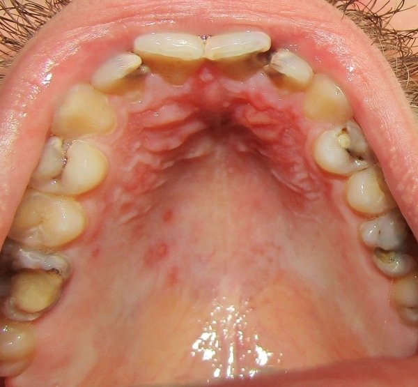Афта во рту: лечение, фото и симптомы афты во рту — ROOTT