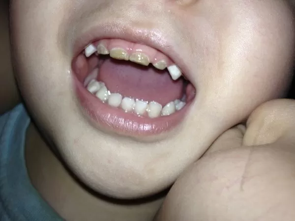 Могут ли зубы почернеть не из-за кариеса?