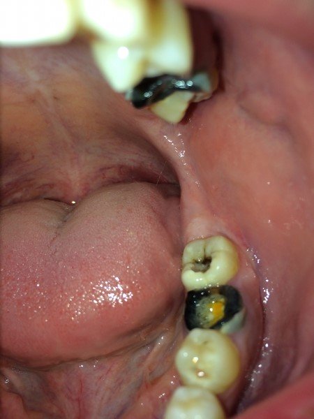 Причины, лечение и возможные последствия гнилых зубов