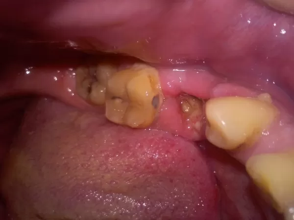 Ангина и боли в горле после удаления зубов мудрости | TopDent | Дзен