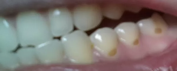 Почему на зубах появляются белые, жёлтые, тёмные пятна