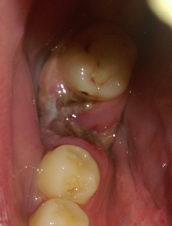 Заживление лунки после удаления зуба - этапы, возможные осложнения, уход