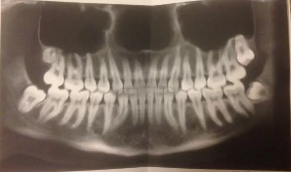 удаление зуба мудрости лицевой нерв