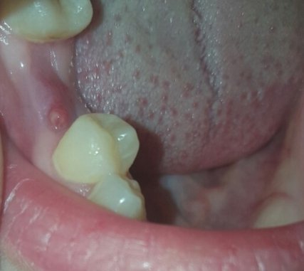 Гноится десна после удаления зуба: причины, симптомы, осложнения