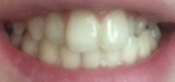 Щели между зубами: почему возникают, как избавиться от диастем