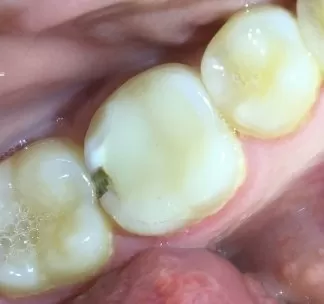 Почему чернеют зубы – общие причины - Министерство здравоохранения Краснодарского края
