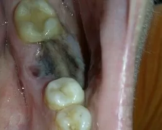 Состояние десны после удаления зуба
