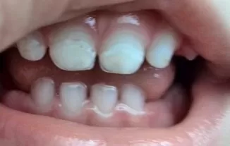 Меловые Пятна На Зубах- 9 Методов Лечения