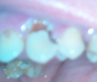 Имплантация зубов при высоком давлении