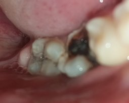 Почему появляются дырки в зубах