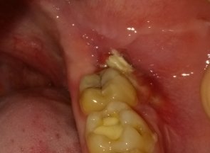 Осложнения во время операции удаления зуба