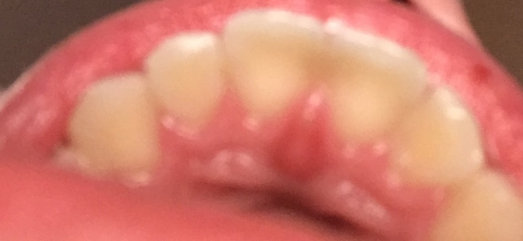Удаление передних зубов - Стоматология Северное Бутово Делия только качественные услуги