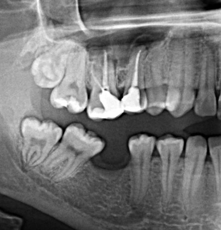 Удаление зуба семерки. Седьмой зуб нижней челюсти.