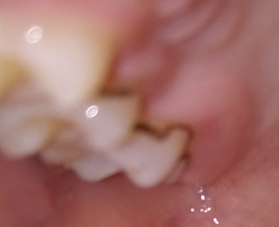 Черный зубной налёт – причины, удаление дома и у стоматолога | Гигиена и Отбеливание
