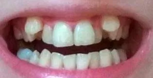 Клык фото зуба. Клыки ра тут поверх зубов.