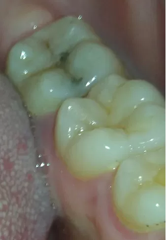 Коричневые пятна на зубах