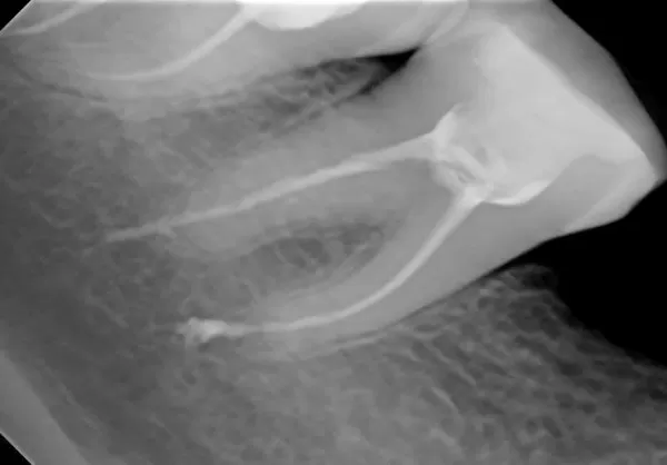 Болит зуб после лечения пульпита (после удаления нерва и чистки канала)
