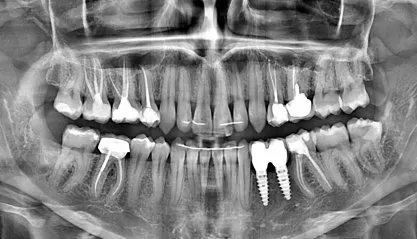 Почему болят передние зубы на нижней челюсти?