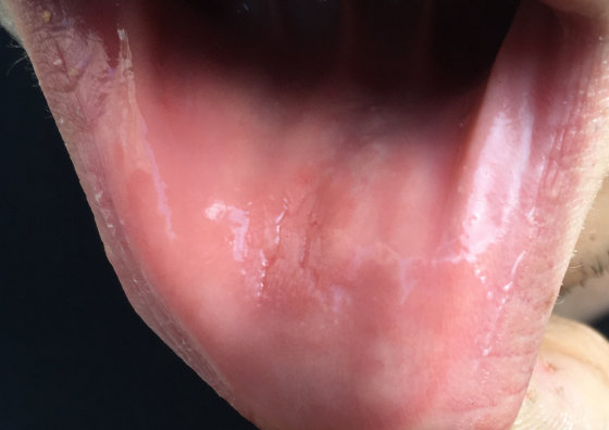 Почему возникает асимметрия после увеличения губ?