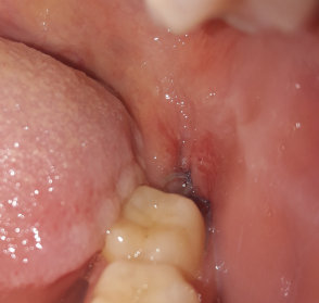 Неприятный запах изо рта после удаления зуба - Стоматология - - Здоровье paraskevat.ru