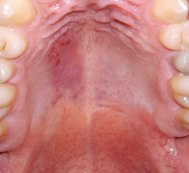 Гематома в полости рта: причины, симптоматика явления и способы лечения