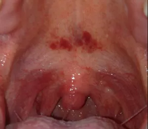 Слизистая оболочка рта: болезни ,симптомы, причины