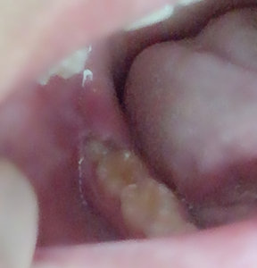 Пульсирующая боль в зубе. Причины и лечение