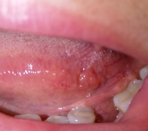 Фиброма десны в полости рта: лечение, может ли рассосаться сама
