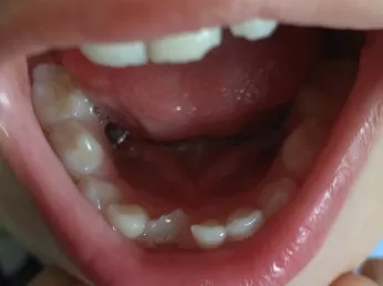 Растут зубы в два ряда у детей: все о второй рядности у ребенка