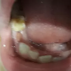 Какой зуб необходимо удалить?
