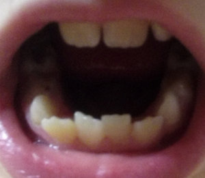 Почему не растут молочные зубы у ребенка? Выпал зуб, новый не растет.