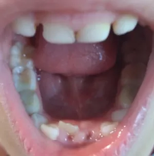 У ребенка растет кривой зуб: что делать?