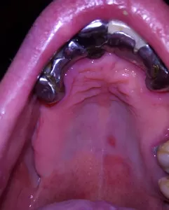 Виды поражений слизистой полости рта