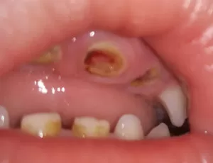 Гнилые зубы - все о причинах и вариантах лечения