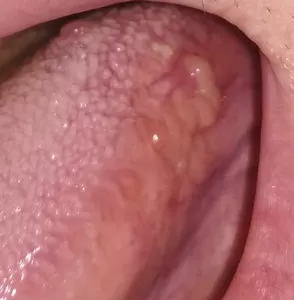 Лечение папилломы полости рта