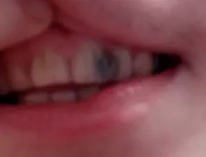 Черные точки на зубах