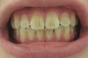 Появление полосок на поверхности зубов, гипоплазия зубов