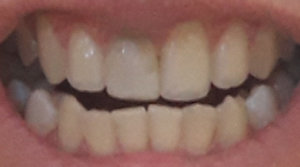 Можно ли восстановить зуб если он сильно поврежден?