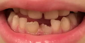 Кривые зубы у ребенка – что делать?