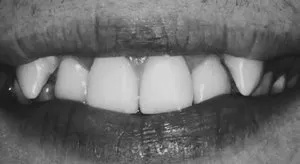 Клыки высокая температура. Клыки высокая температура. Клыки высокая температура. Клыки высокая температура. Зубы прорезывание у детей.