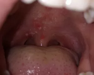 Как лечить воспаление под языком